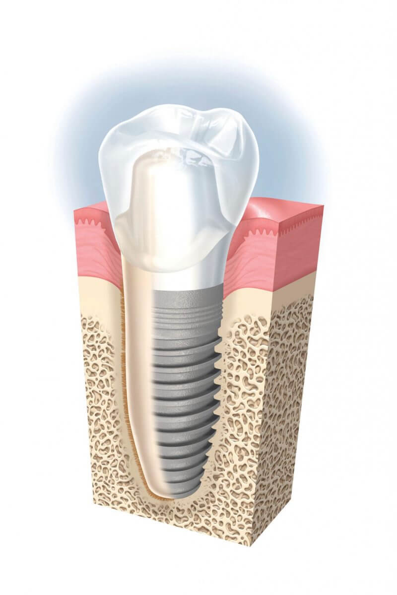 Prix couronne sur implant clinique Vieux Sherbrooke