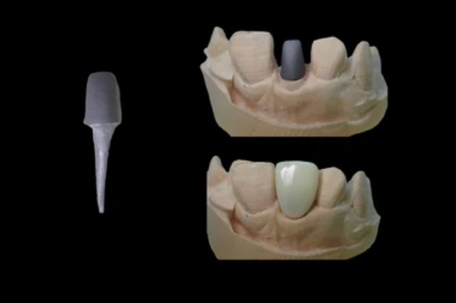 Crown pivot at Vieux Sherbrooke dental clinic