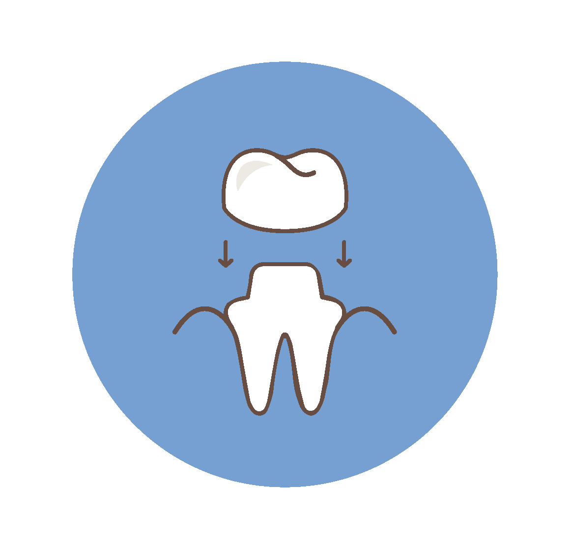 Incrustations et couronnes de type CEREC