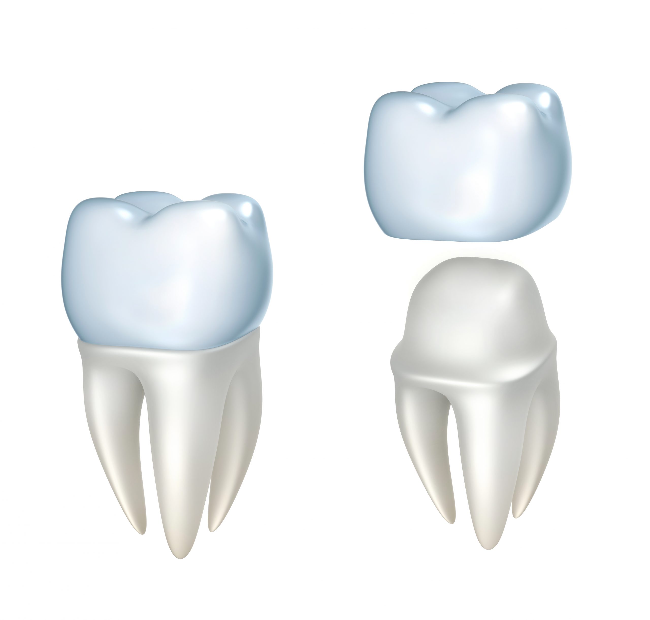 Couronne dentaire, pivot, couronne sur implant, qu'est-ce que c'est?